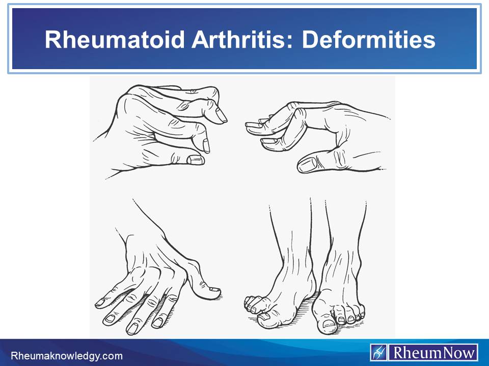 RA%20deformities.jpg