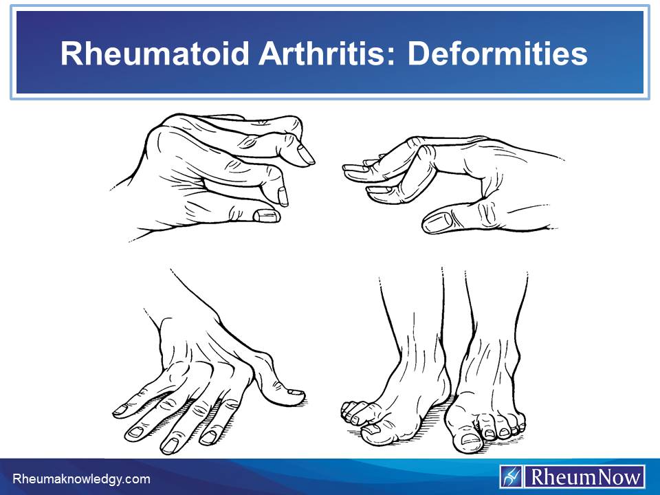 RA%20deformities_0.jpg