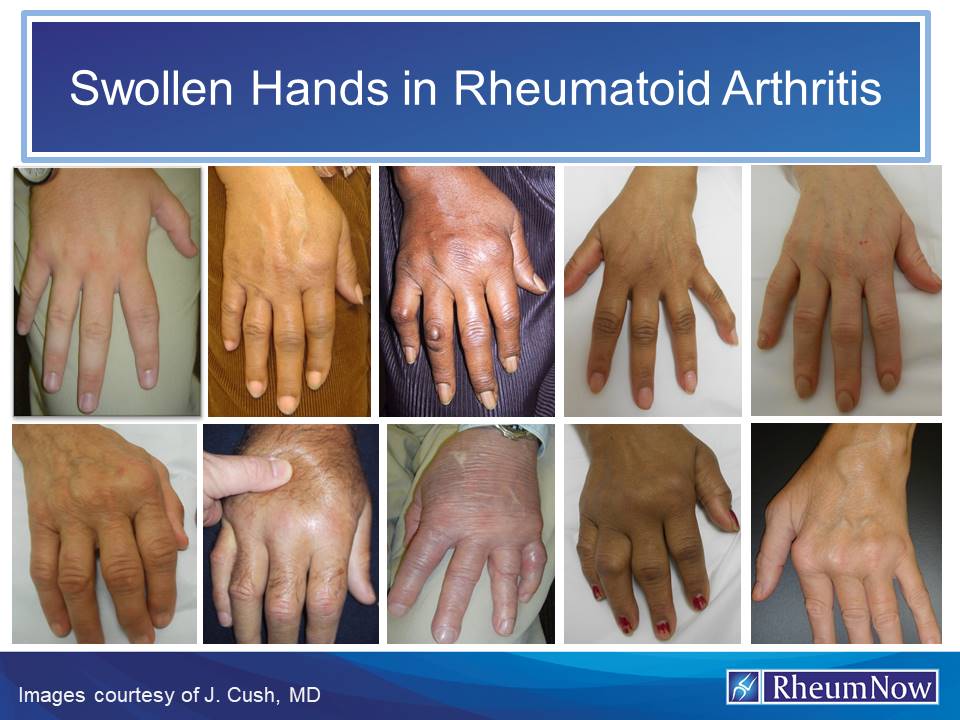 Swollen%20Hands%20RA.1.jpg