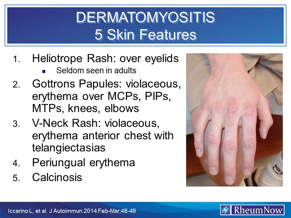 dermatomyositis%205%20skin%20manifestations.jpg