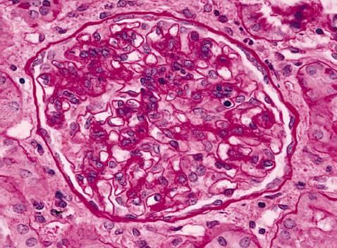 Class IV glomerulonephritis