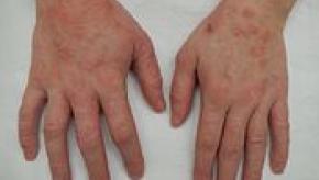 175px-Dermatitis2015.jpg