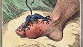 196px-The_gout_james_gillray.jpg