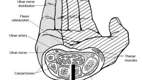 Carpal-Tunnel-Syndrome.jpg