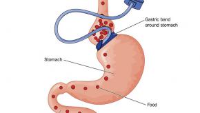 Gastric.band_.weight.loss_.jpg