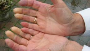 Raynaud-hand2.jpg