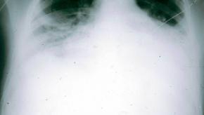 aosd.CXR_.jpg (keep)