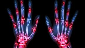 arthritis.RA_.Xray_.hands_.jpg (keep)