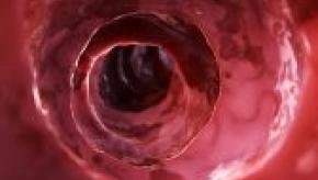 colitis.jpg