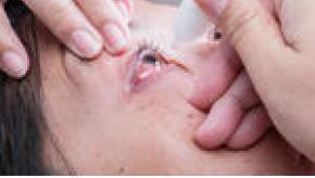 conjunctivitis-eyes-216074398.jpg