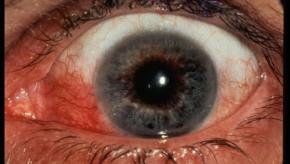 episcleritis.jpg