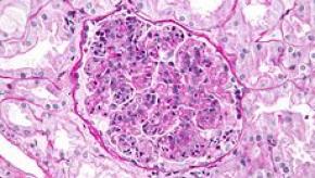 glomerulonephritis.jpg