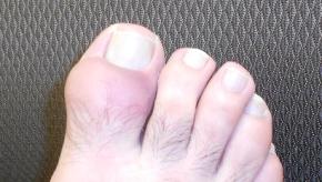 gout.bigtoe1.jpg (keep)