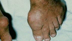 gout.podagra2.jpg
