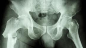 hip-fracture.jpg
