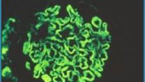 lupus.nephritis.immunofluorescence.jpg