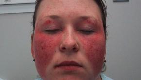 malar.bad_.jpg (keep)