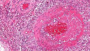 vasculitis.Churg-Strauss_syndrome.wikipedia.jpg