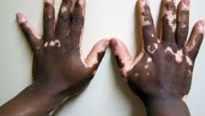 vitiligo.jpg