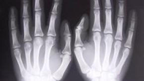 xray-of-hands-1526780.jpg