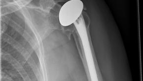 TSR Shoulder replacement