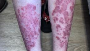 Psoriasis Severe legs sara