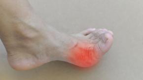 gout podagra inflammed