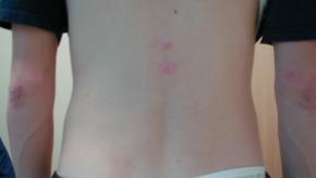 Lumbar rash DM
