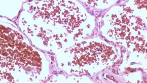 alveolar hemorrhage acute