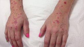 Psoriasis, arms, PsA