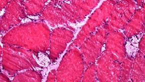 pompe myopathy glycogen muscle