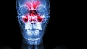 Sinusitis Xray maxillary skull
