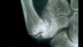 CMC1, thumb, hand, xray