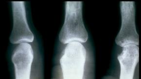 RA erosions bone ACR