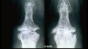 OA, erosive, inflammatory, DIP