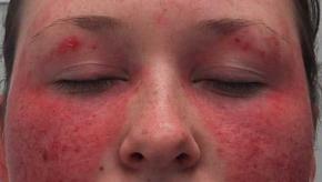 Malar,rash,SLE, Lupus