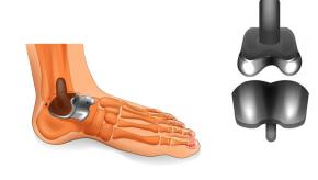 TAA, TAR, Ankle, replacement