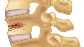 Vertbral,Fracture,spine,compression