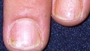 Nail, pitting, psoriasis, onycholysis