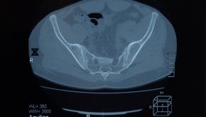 SI,Sacroiliac,Erosion,MRI