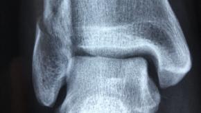 ankle,xray