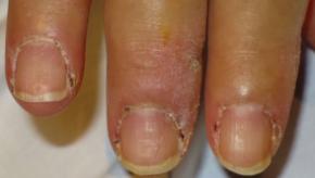 antisynthetase,myositis,nail,erythema