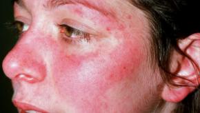 Lupus,flare,malar,DermNetNZ