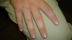 undifferentiated,arthritis,early,RA