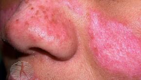 Cutaneous.lupus.SLE.Face.dermnetnz