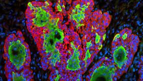 Skin,cancer,squamous,cell