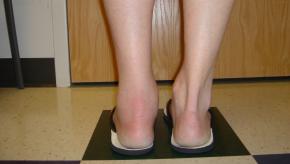 Heel, pain,enthesitis,achilles