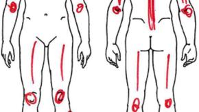 Pain,FM,fibromlyalgia,Trigger