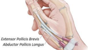 dequervain,tenosynovitis