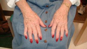 OA, Hands, Frail, Woman